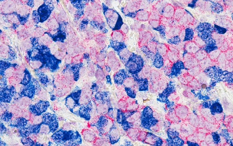 Microscopic image of breast cancer cells