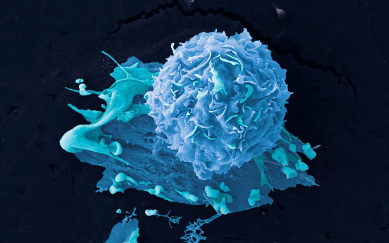 Microscope image of breast cancer cells