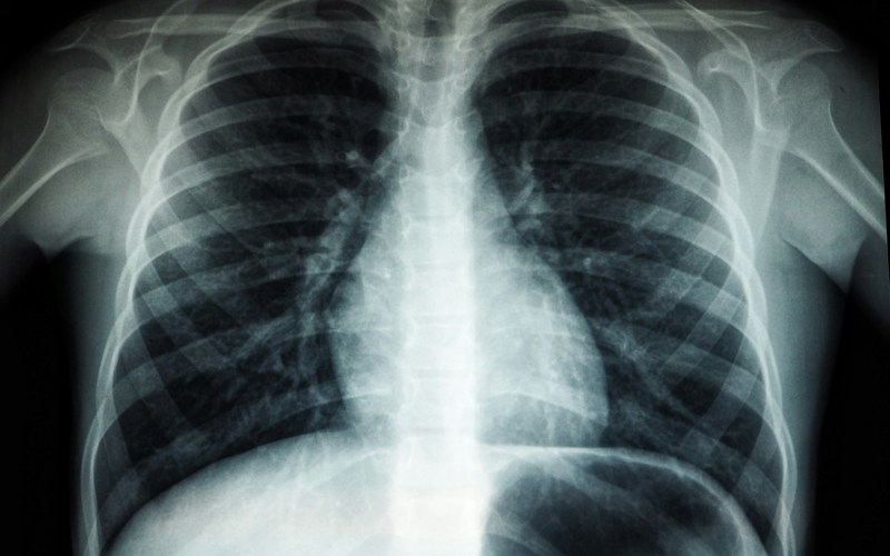 x-ray image of a rib cage