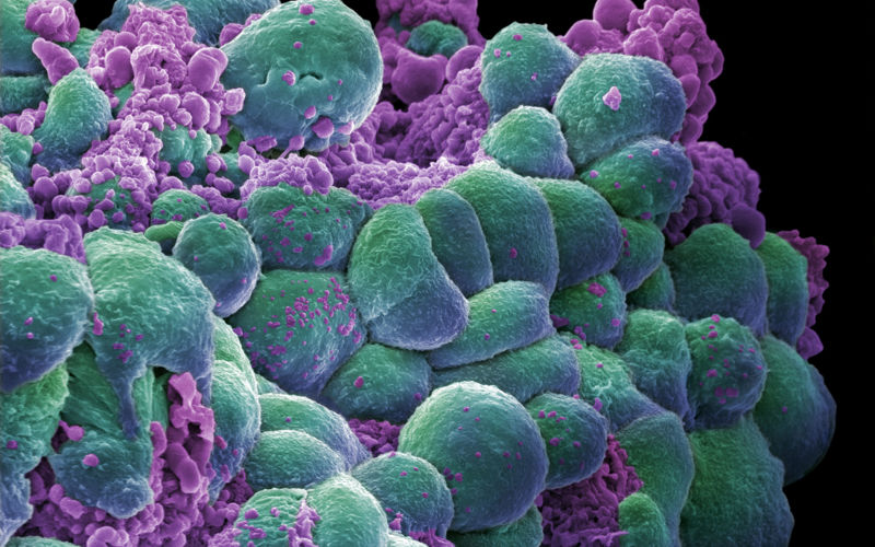 Microscopic image of breast cancer cells