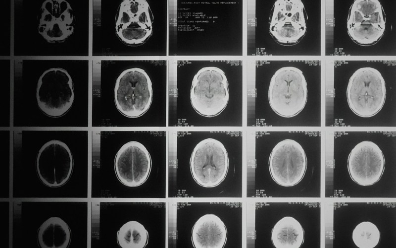 Black and white brain scans